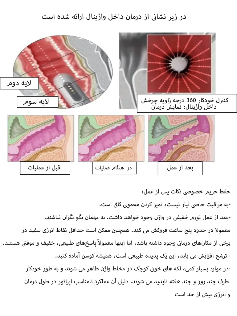 دستگاه هایفو 4 بعدی دو هندپیس واژنال