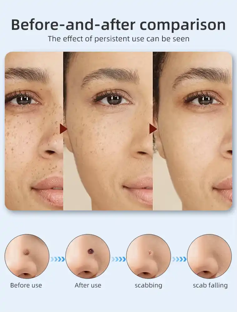 beauty model removal sweep 0002 دستگاه بیوتی پن 9 زمانه دیجیتالی